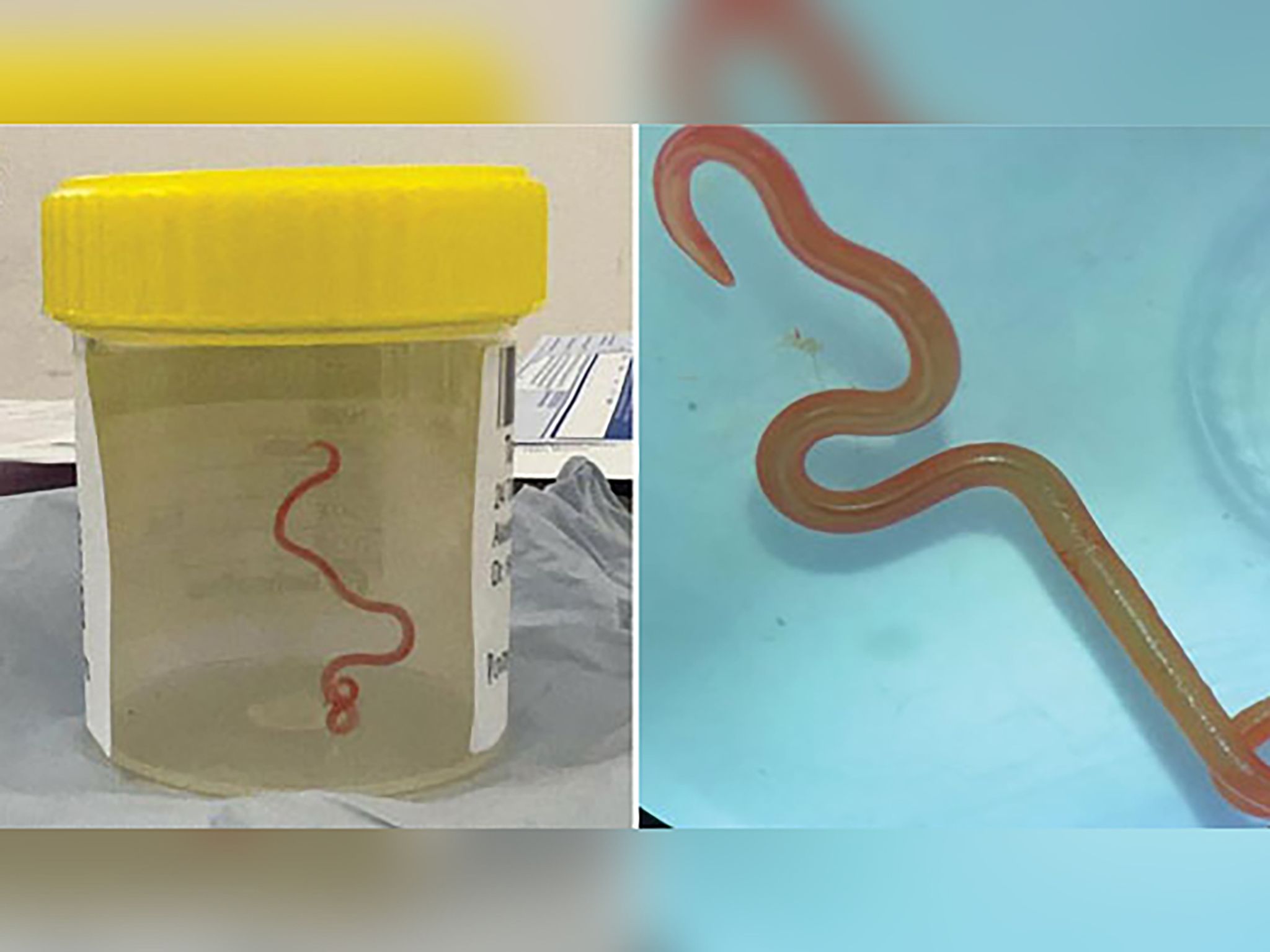 Das Undatiertes Bild Zeigt Den Lebenden Spulwurm «Ophidascaris Robertsi», Der Im Gehirn Einer 64-jährigen Australierin Gefunden Wurde.
