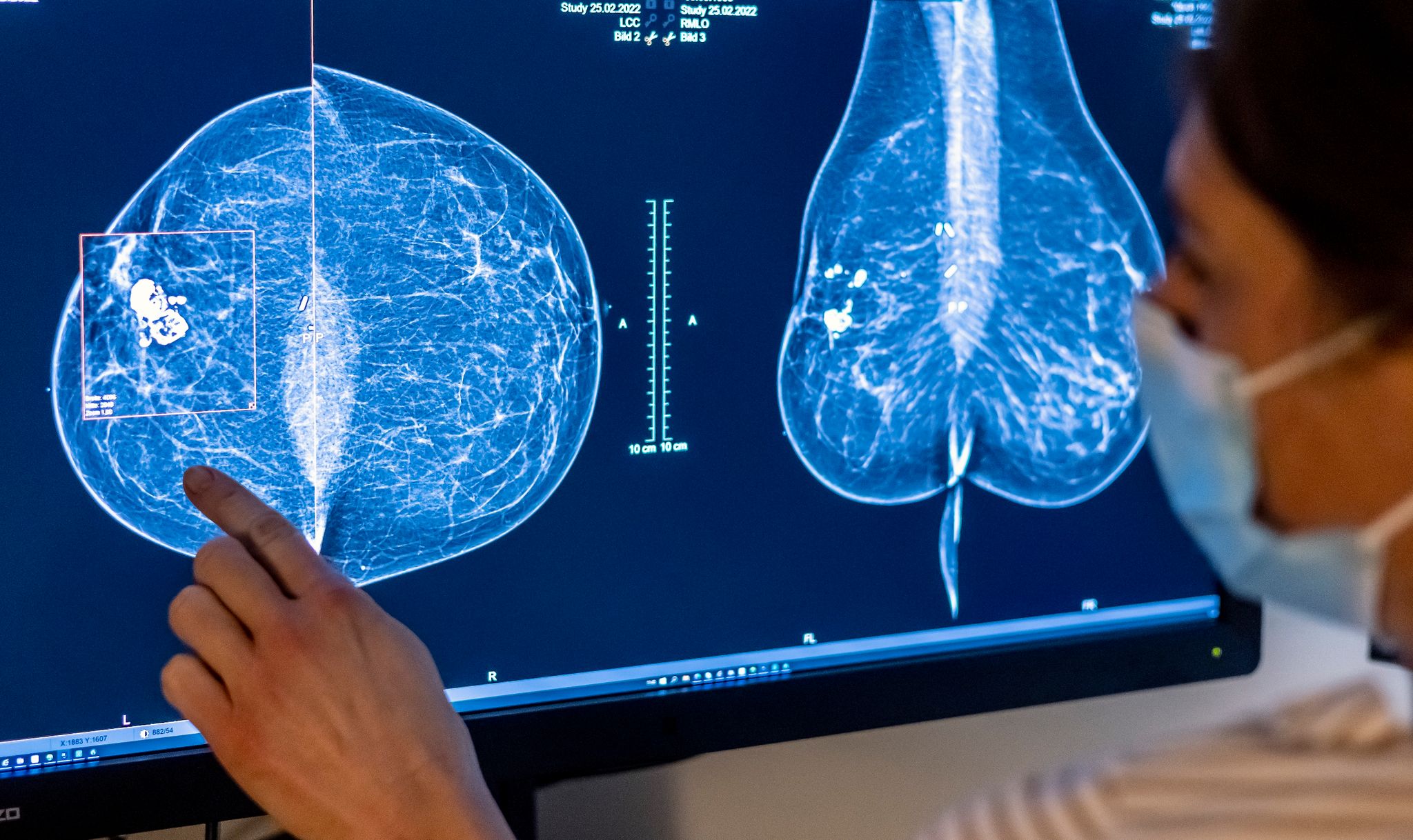 Die Möglichkeiten Zur Mammographie Für Die Früherkennung Von Brustkrebs Soll Ausgeweitet Werden.
